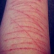 self harm